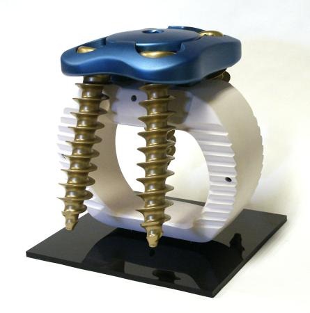 Spine Implant Model